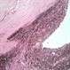 Tumor invading sclera Tumor invading sclera